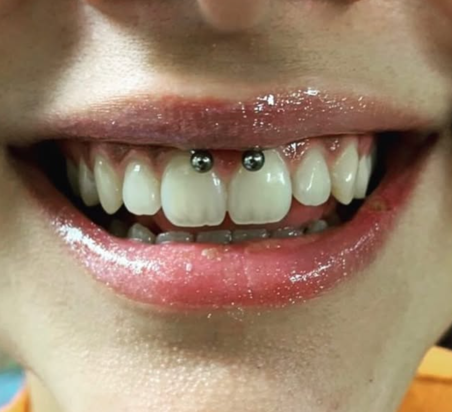 Smiley piercing at Two 0 Six Tattoo, Ottawa piercing studio